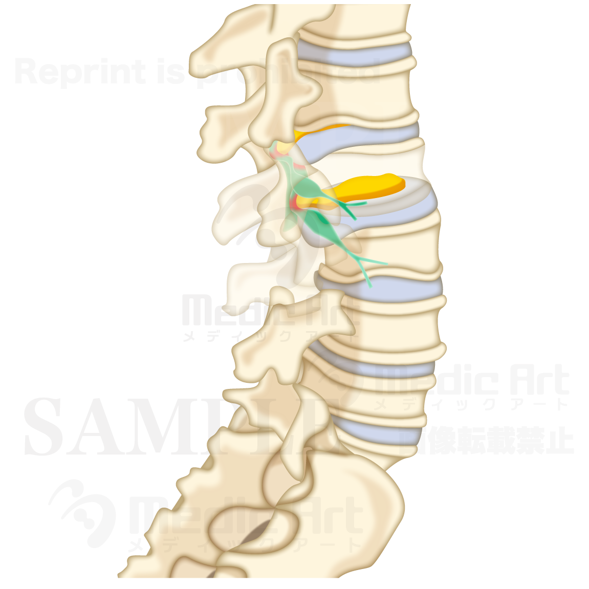 椎間板ヘルニアの腰椎（ようつい）