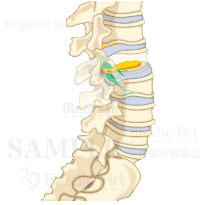 椎間板ヘルニアの腰椎（ようつい）