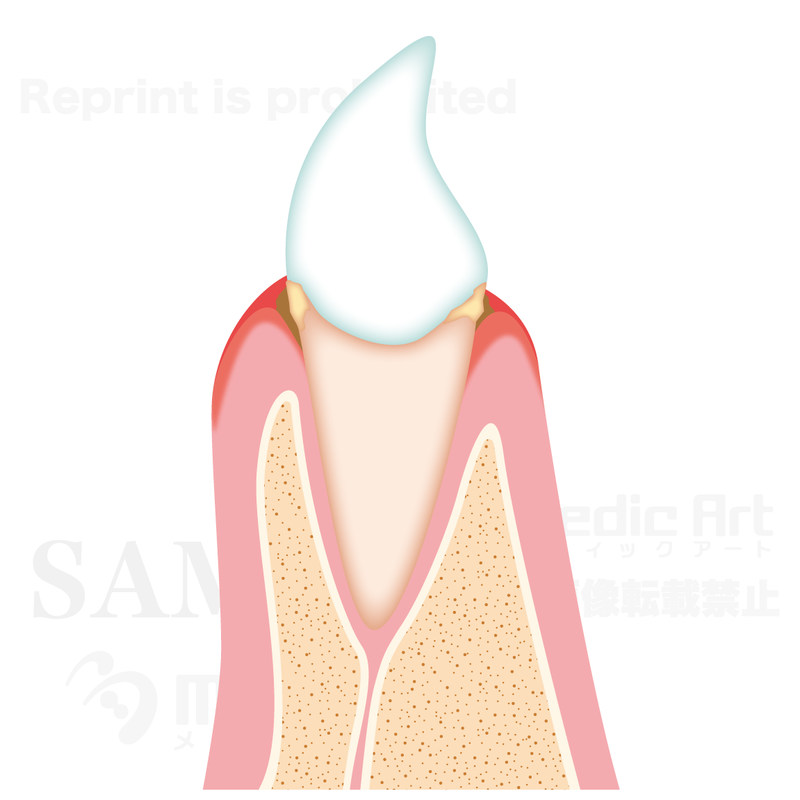 The progression of periodontal diseases 1 (gingivitis)