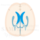 Horizental section of Cerebralventricle1(Judging from superior aspect)