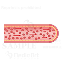 Progress of arteriosclerosis 1(case of normal blood vessel)