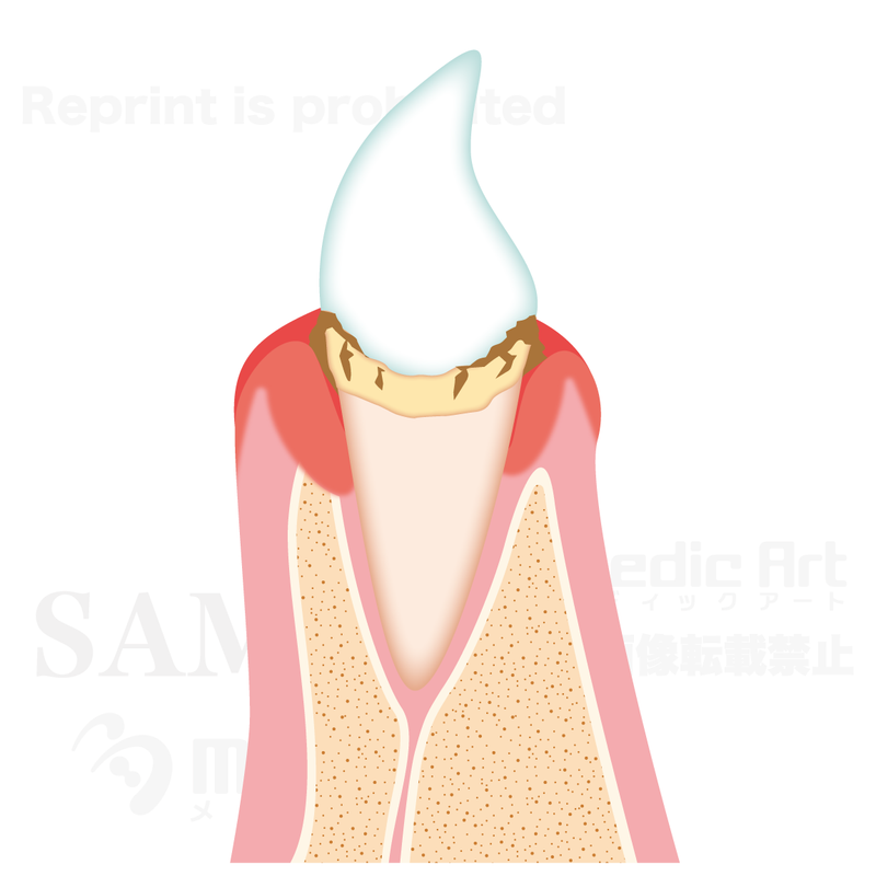 The progression of periodontal diseases 2 (initial periodontitis)