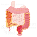 Ulcerative colitis and Crohn's disease