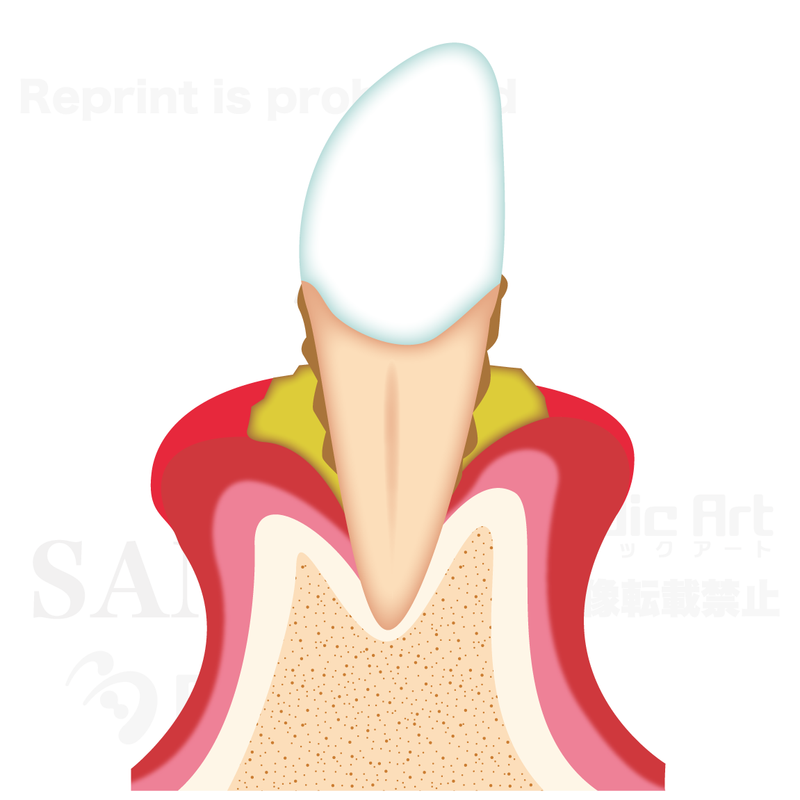 The progression of periodontal diseases. 3 (moderate periodontitis)