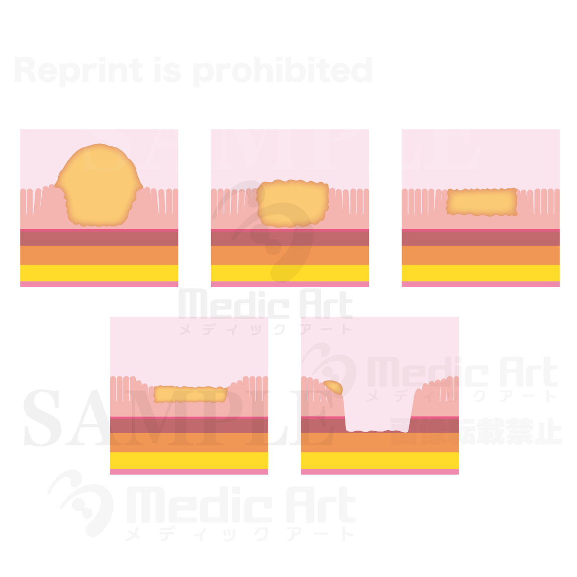 早期胃がんの分類