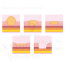 Types of early stage stomach cancer