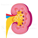 kidney renal cell carcinoma: Renal pelvic cancer