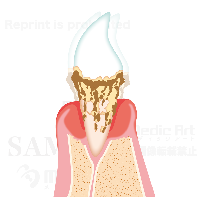 The progression of periodontal diseases. 4 (severe periodontitis)