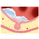 Mechanism of the bronchial asthma(Enlarged picture of bronchus)