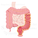 A colorectal polyp and colorectal cancer