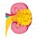 kidney renal cell carcinoma; Renal pelvic cancer