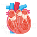 Dilated cardiomyopathy　