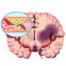 Cerebral infarction : Atherothrombotic infarction 