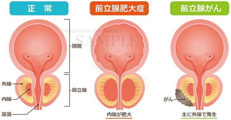 正常な前立腺と前立腺肥大症、前立腺がん［日本語の文字付］
