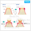 The progression of periodontal disease 【F：with letters