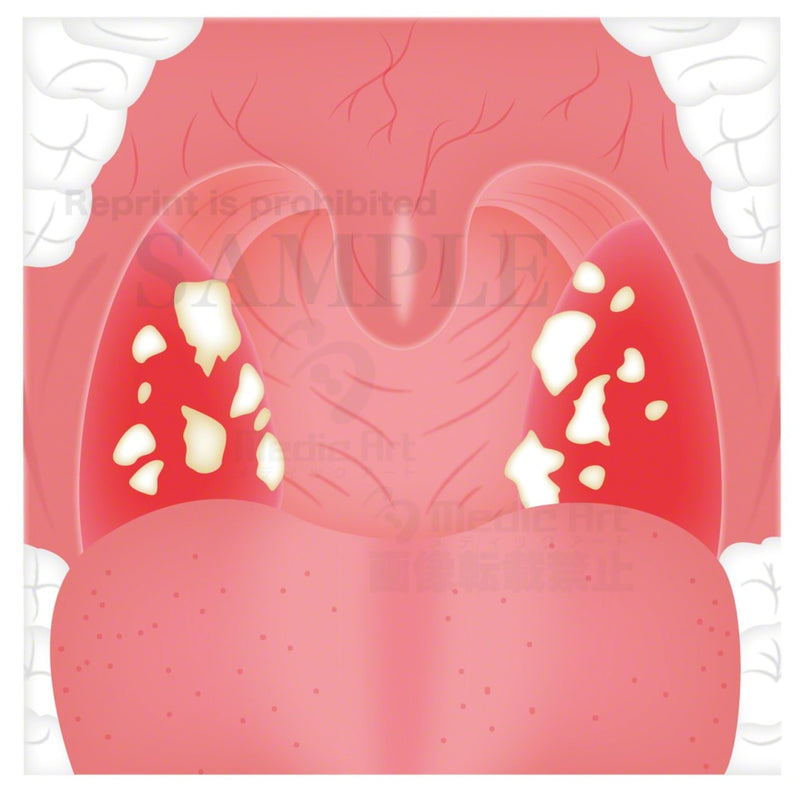The acute tonsillitis