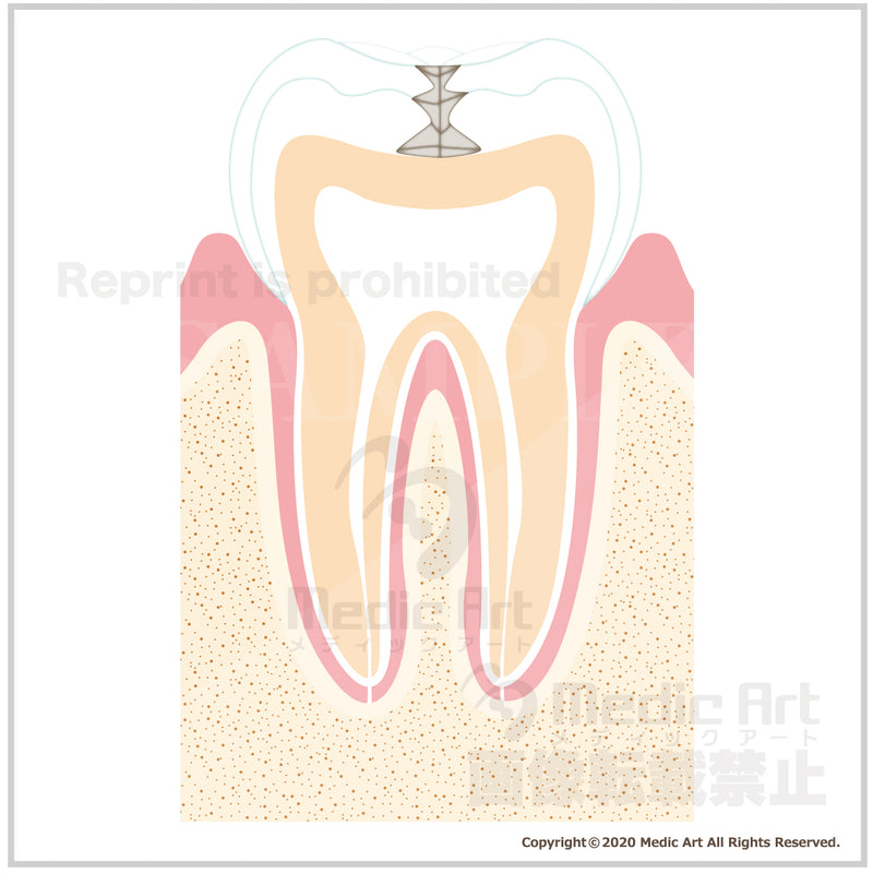 虫歯の進行と治療1