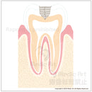 Progression of dental caries and treatment 2