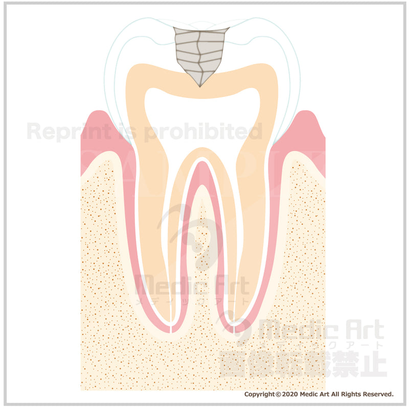 虫歯の進行と治療2