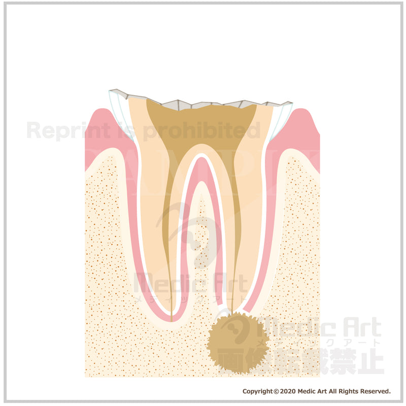 虫歯の進行と治療4a