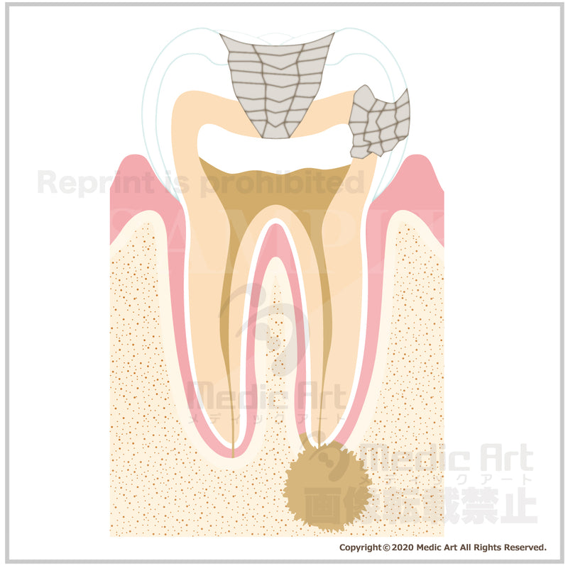 虫歯の進行と治療3b