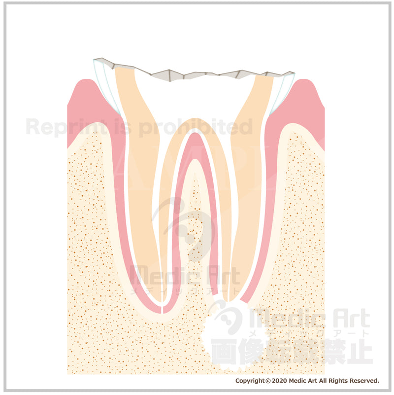 虫歯の進行と治療4b