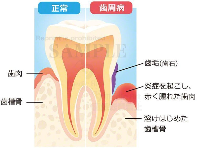 Comparison of normal teeth and periodontal teeth[with Japanese characters]