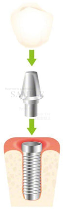 Mechanism of implant (artificial tooth root)