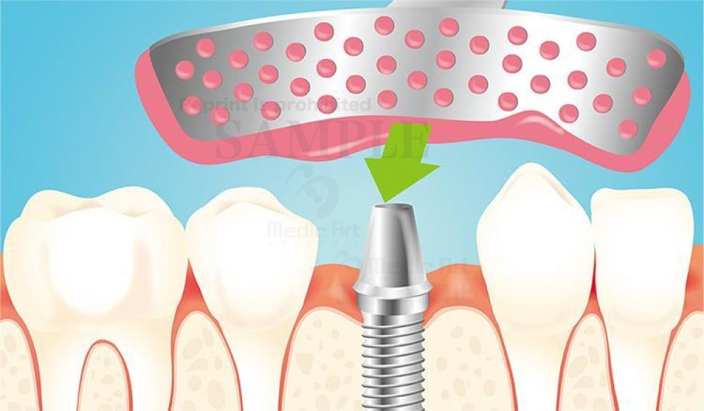 人工歯を作るための型をつくる