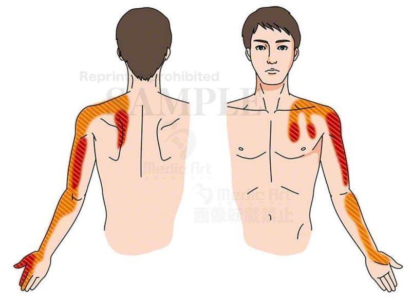頸肩腕症候群（けいけんわんしょうこうぐん）でしびれる範囲