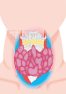 Women of Hypothyroidism (Basedow disease)