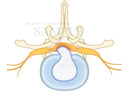 Lumbar of disc herniation