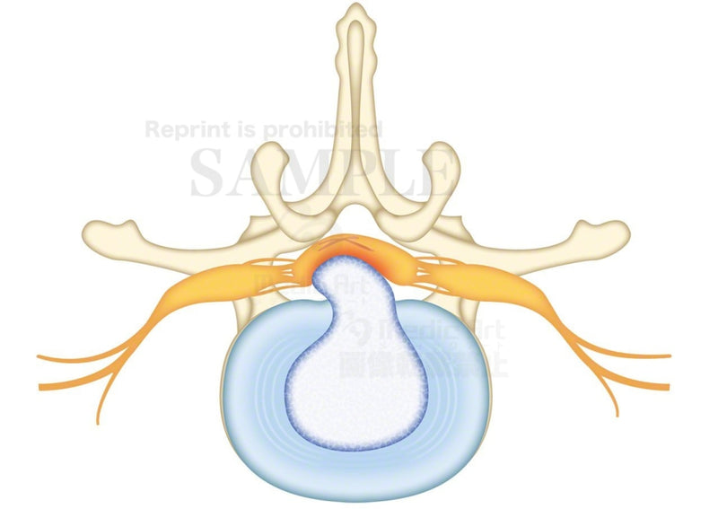 Lumbar of disc herniation