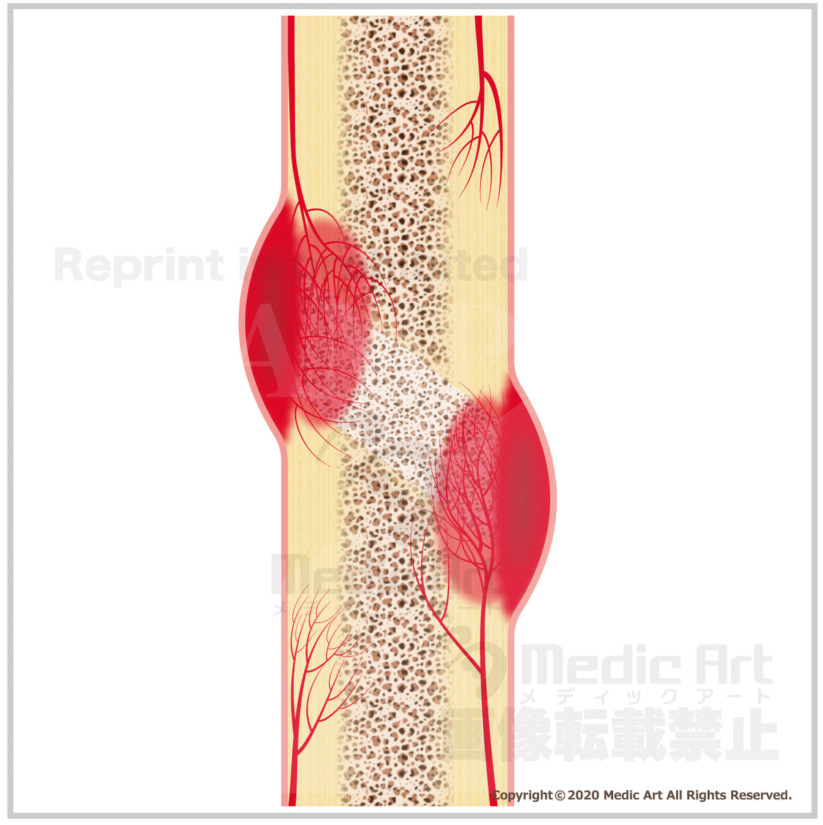 PATH_AT_broken-bone2_1200x.jpg