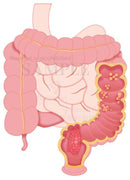 A colorectal polyp and colorectal cancer