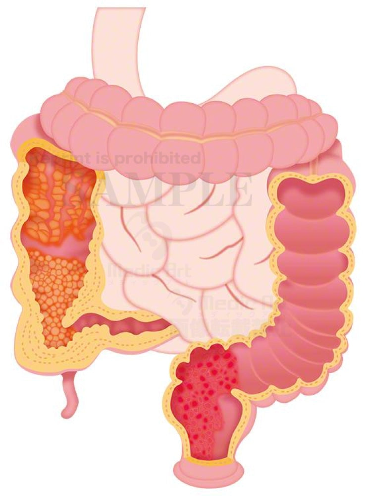 Ulcerative colitis and Crohn's disease