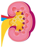 kidney renal cell carcinoma: Renal pelvic cancer