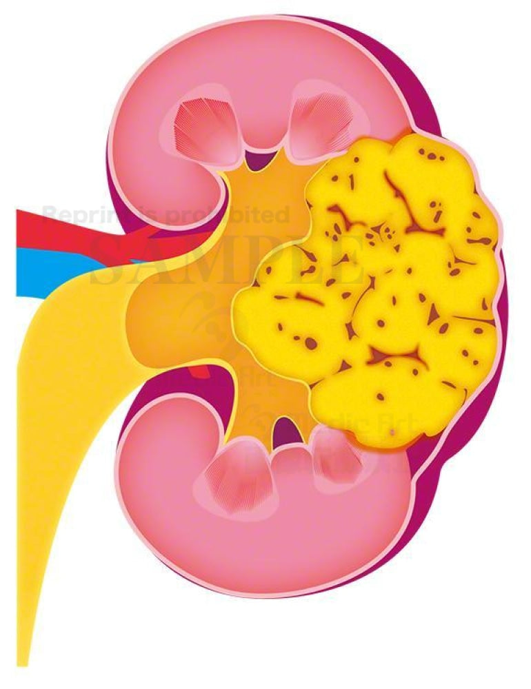 kidney renal cell carcinoma; Renal pelvic cancer