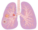 Lung cancer