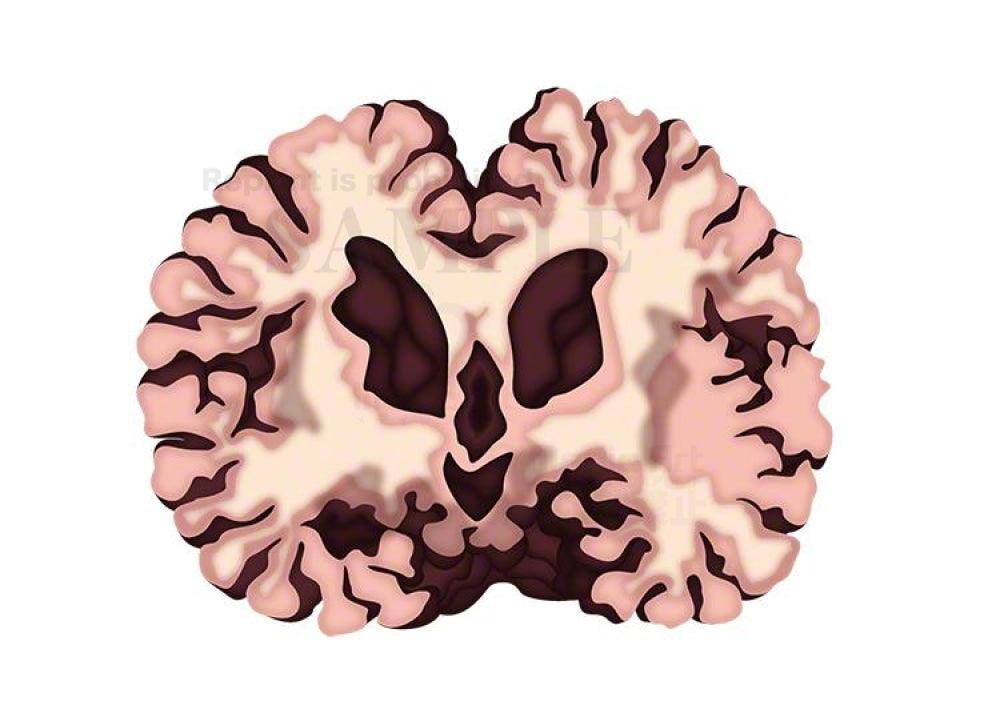アルツハイマー病（アルツハイマー型認知症）