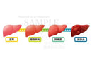 正常な肝臓、慢性肝炎、肝硬変、肝がん