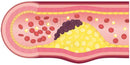 Progress of arteriosclerosis 4(case of normal blood vessel)