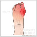 Foot that is causing the gout attack