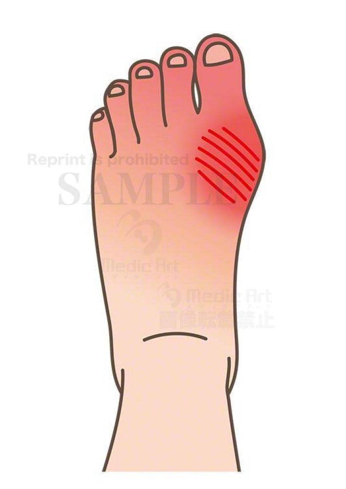 Foot that is causing the gout attack