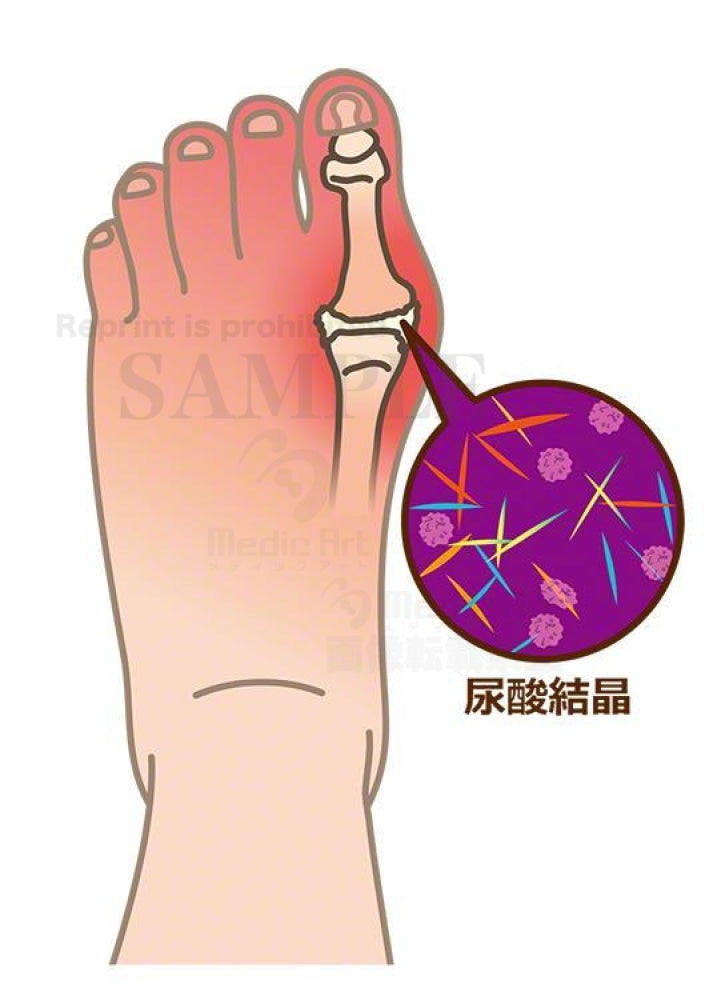 Foot that is causing the gout attack(With image view of the uric acid crystals)