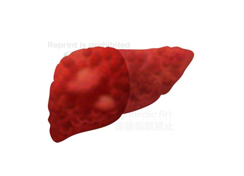 Liver cancer (Ｈepatocellular cancer)