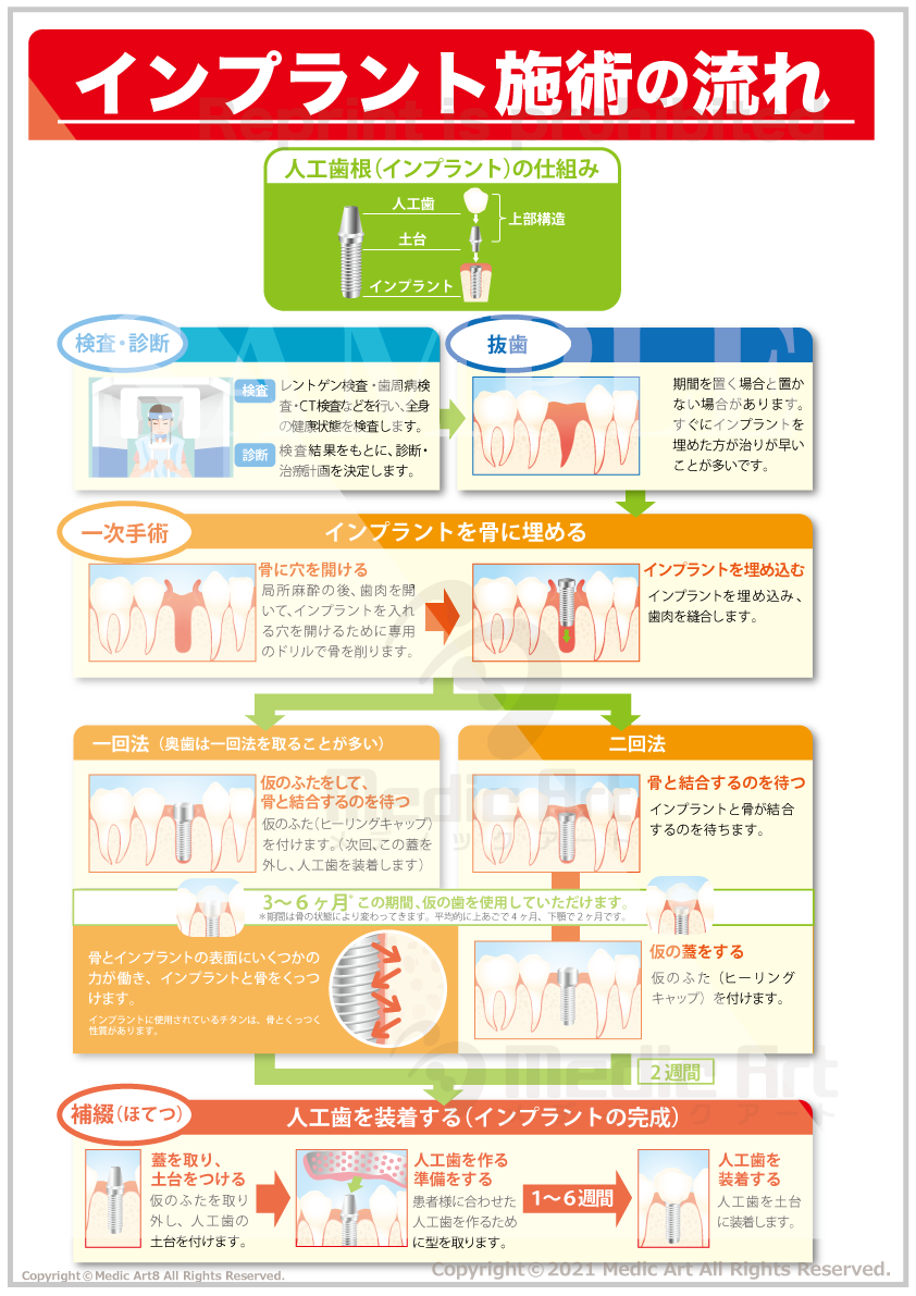 インプラント施術の流れ ［シート］