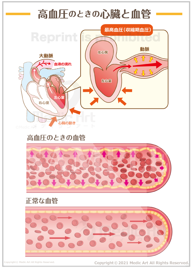 最高血圧の心臓と血管 ［シート］