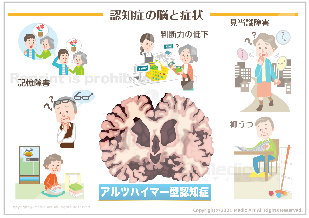 アルツハイマー型認知症の脳と症状 ［シート］