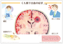 くも膜下出血の症状 ［シート］